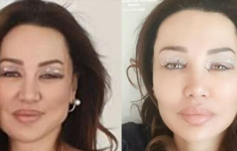 Bu kez de göz kapağı ameliyatı oldu 